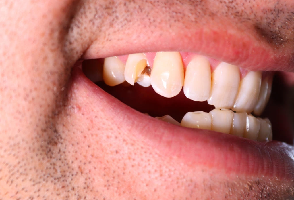 Broken Wisdom Tooth