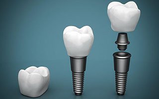 Dental Implants | My Local Dentists West Ryde