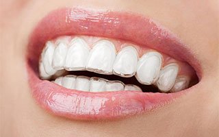 Invisalign | My Local Dentists West Ryde
