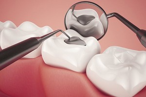 Lost Tooth Filling or Dental Crown Emergency | Dentist West Ryde
