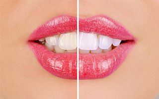 Teeth Whitening | My Local Dentists West Ryde