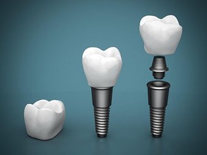 My Local Dentists My Local Dentists West Ryde Implants | Dentist West Ryde