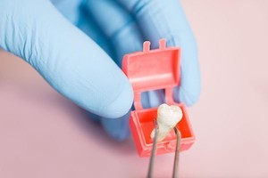 Wisdom Tooth Removal Dentist West Ryde