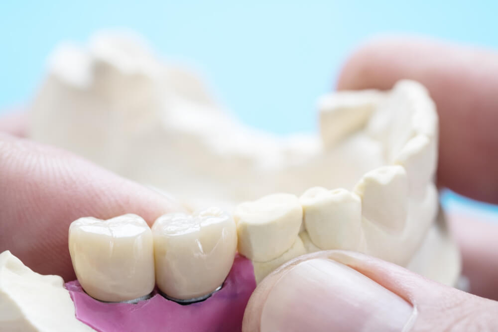 do permanent dental crowns last forever
