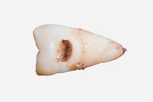 fractured wisdom tooth